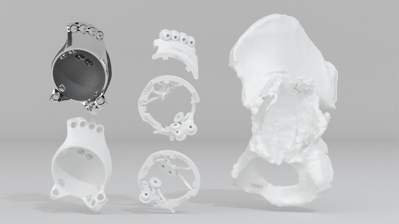 Индивидуальный протез, напечатанный на 3D принтере